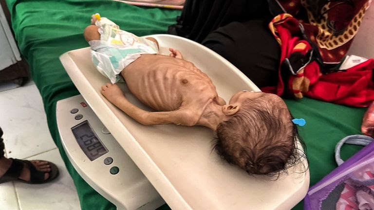 Update: More than 600.000 children in Yemen suffer from severe accute malnutrition