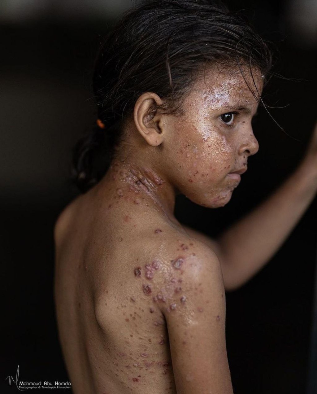 Skin diseases and other illnesses caused by deliberate blockade of  hygiene and sanitary&nbsp;products